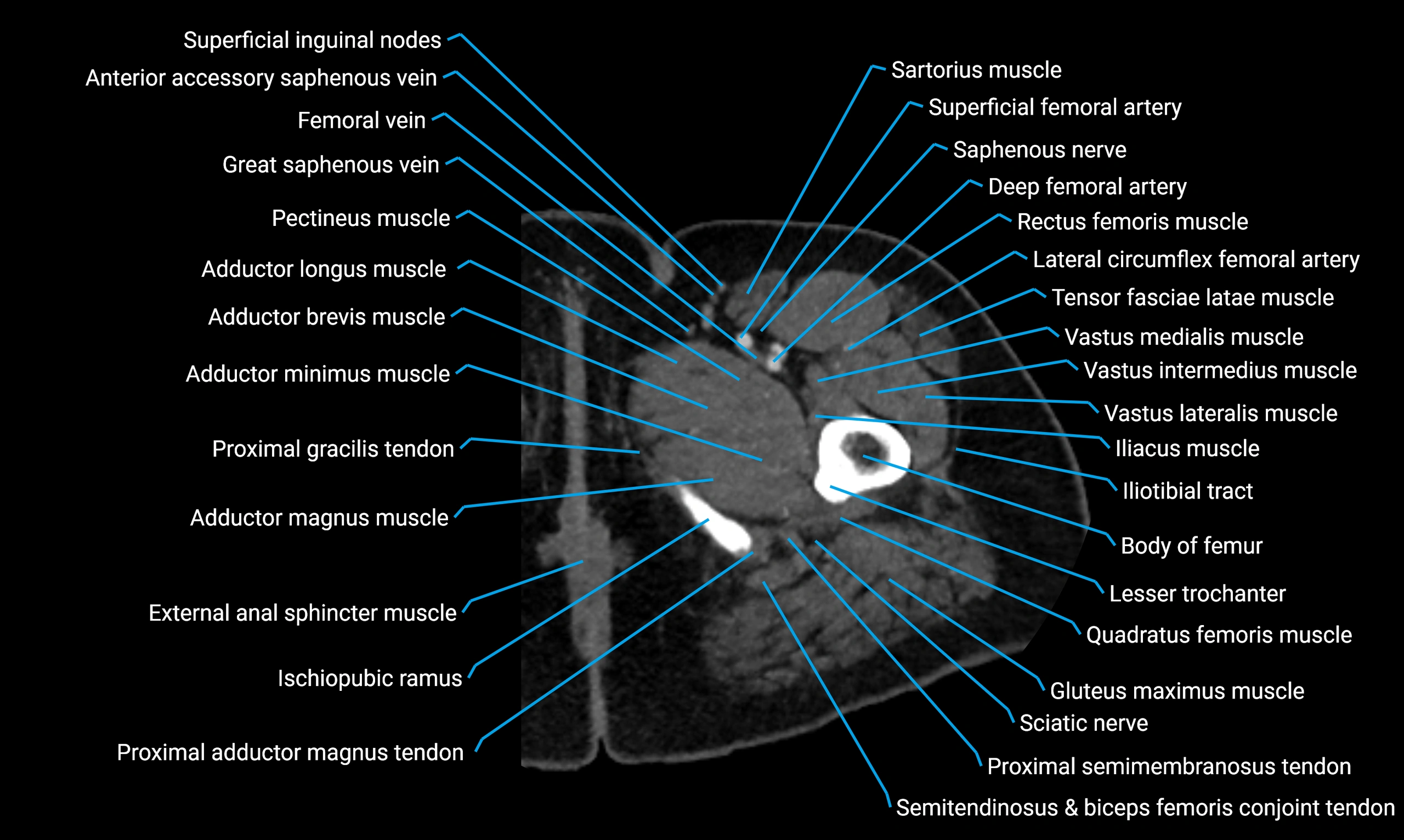 CT thigh axial cross sectional anatomy labelled image_19 (2).webp
